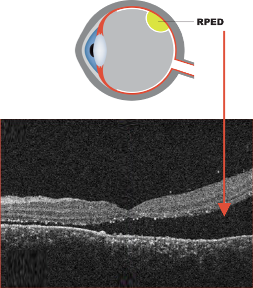 Optical coherence tomography (OCT) image of exudative retinal detachment
