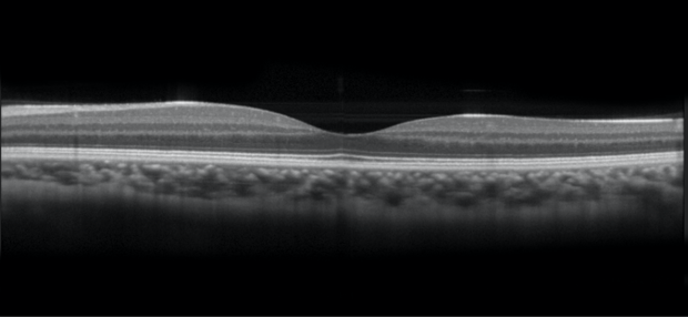 Optical coherence tomography (OCT) image of normal retina