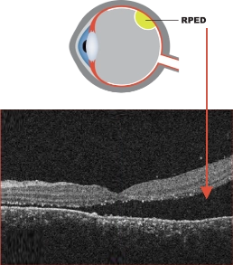 Optical coherence tomography (OCT) image of exudative retinal detachment